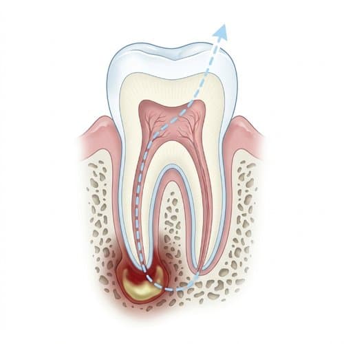 Medical illustration of a tooth with a root infection and treatment path—abscess and urgent care